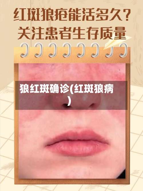 狼红斑确诊(红斑狼病)