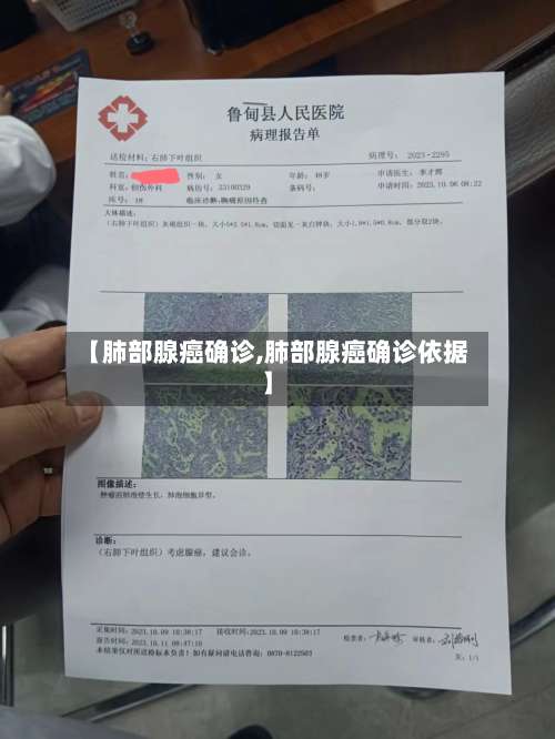 【肺部腺癌确诊,肺部腺癌确诊依据】-第2张图片