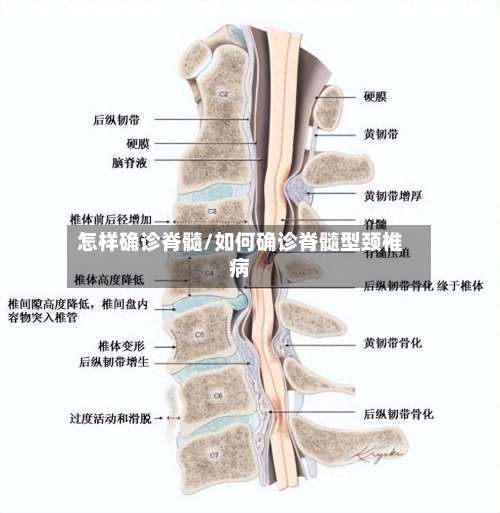 怎样确诊脊髓/如何确诊脊髓型颈椎病