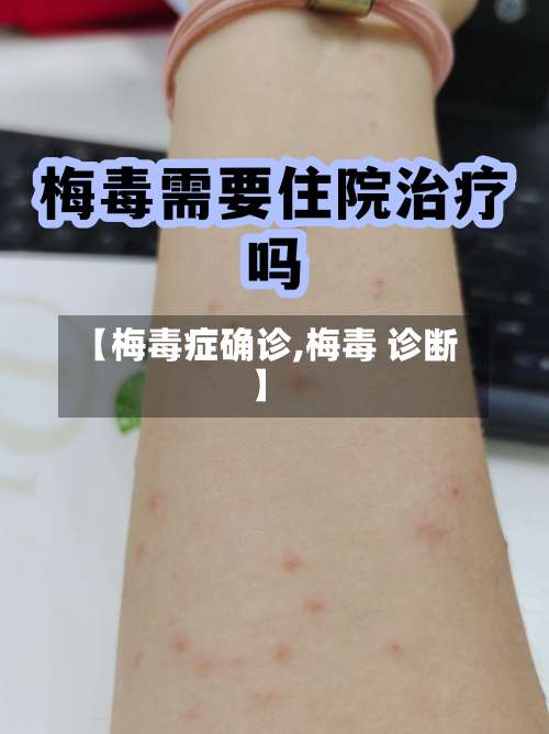 【梅毒症确诊,梅毒 诊断】
