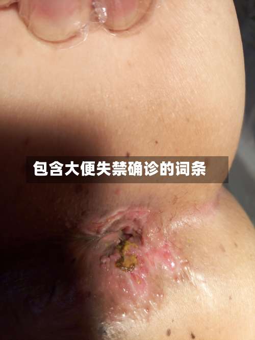 包含大便失禁确诊的词条