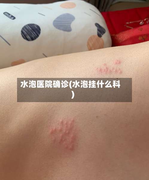 水泡医院确诊(水泡挂什么科)-第2张图片